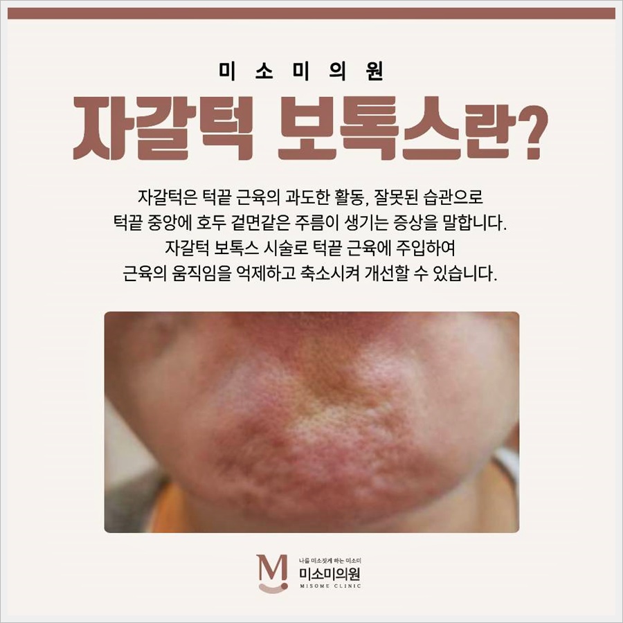 영등포피부과 턱끝근 수축으로 나타나는 자갈턱 증상