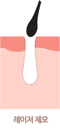 레이저 제모